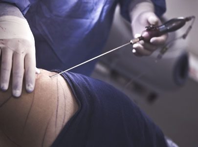 Lipoaspiracao-Em-Sao-Paulo-Nos-Jardins-Dr-Alberto-Okada-Essere