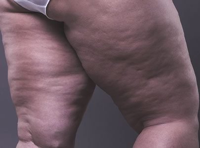 Tratamento-Linfedema-Em-Sao-Paulo-Nos-Jardins-Dr-Alberto-Okada-Essere